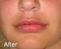 Luscious Lips after - Wrinklefree.ie